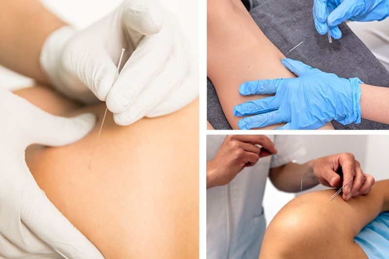 Pros and Cons of Dry Needling: A Needle Away From Relief